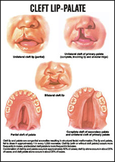 Cleft lip-Palate