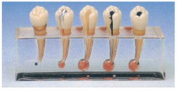 Clinical model of Endodontics