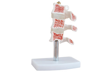 Cutaway Osteoporosis