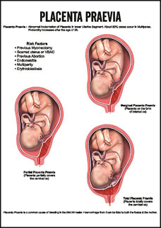 Placenta Praevia