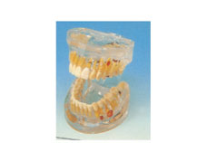 Transparent Dental Pathology Model